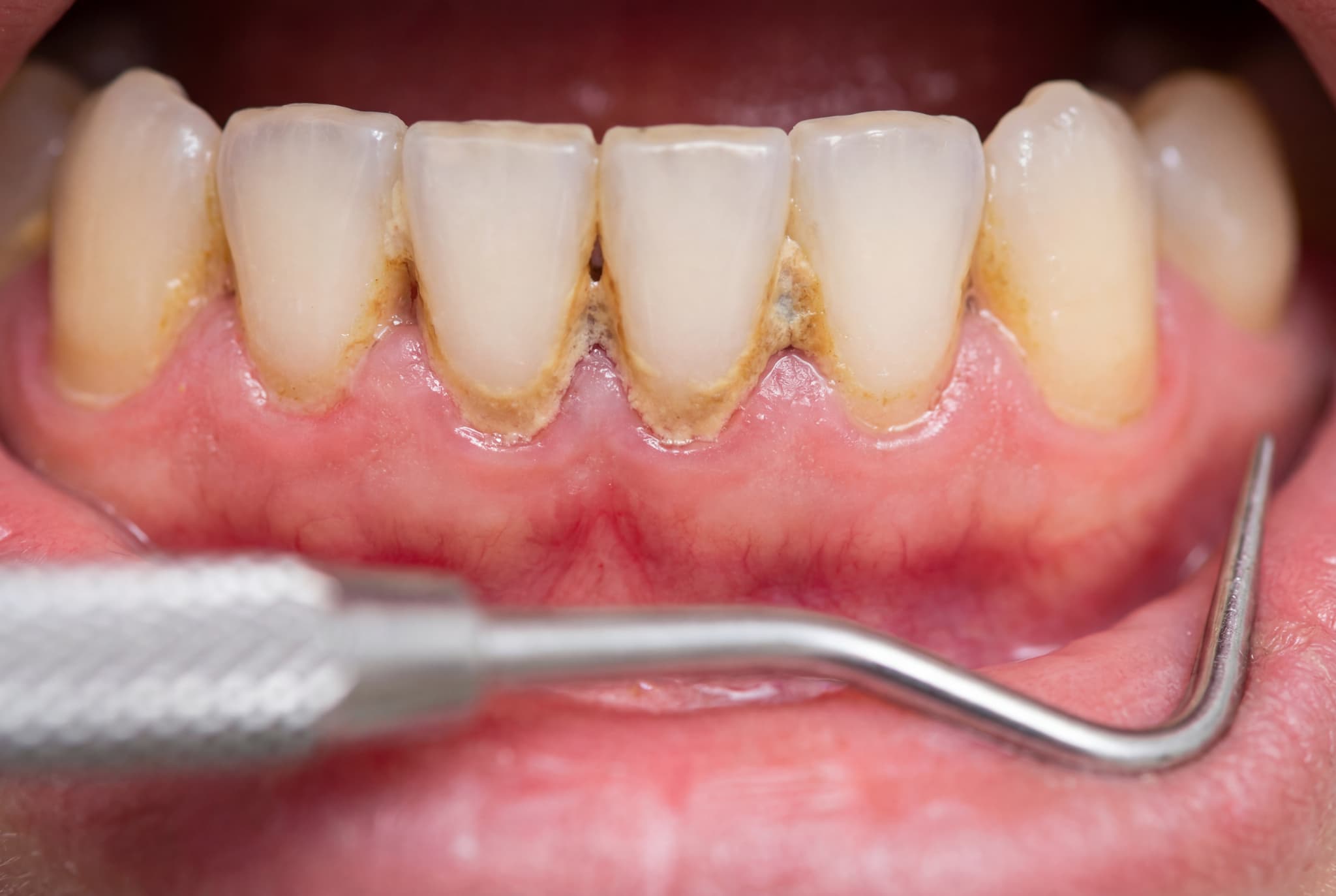 歯石が溜まった口腔内