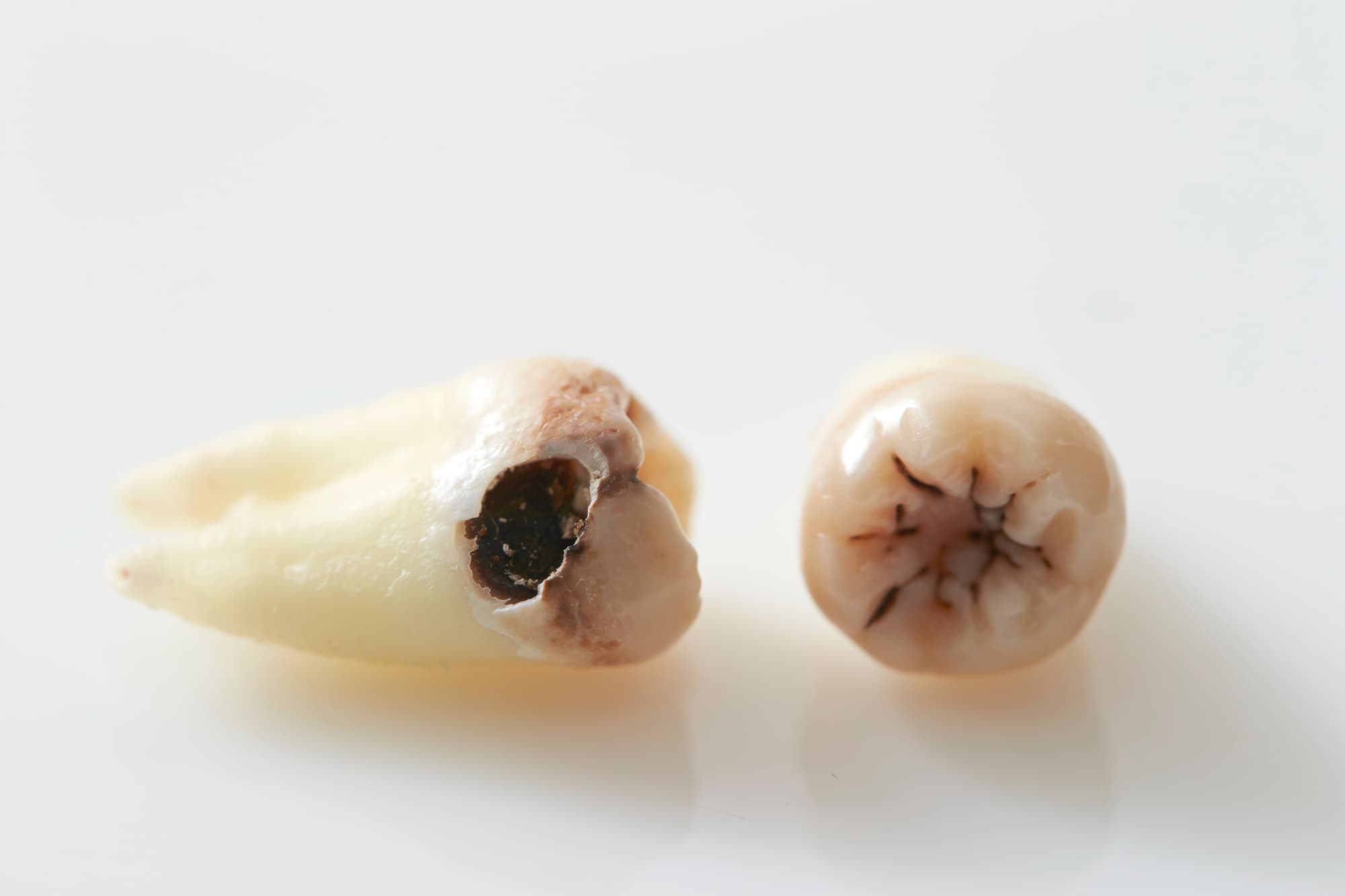 虫歯になった歯