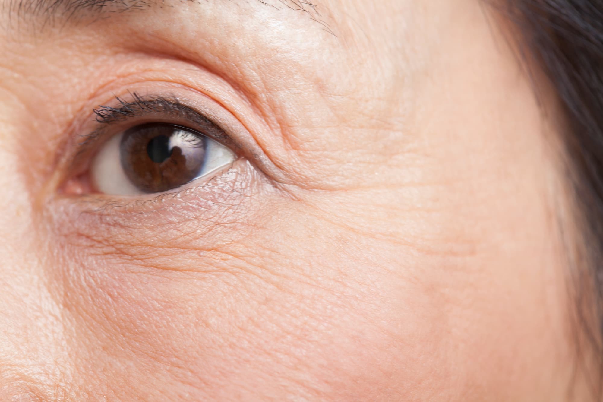 年齢による瞼のたるみ